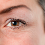 фото морщин вокруг глаз до начала пользования препаратом Сиролимус