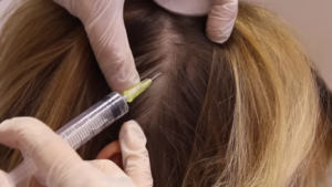 Мезотерапія волосся в надійному косметологічному центрі Полтави - ESTET